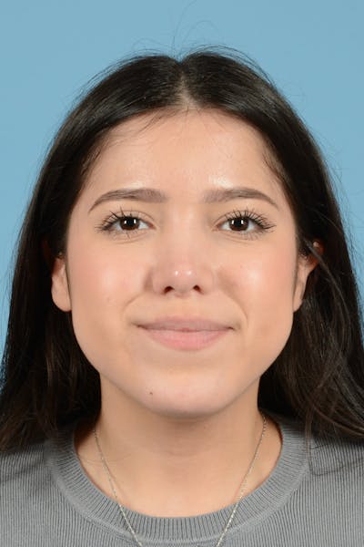Facial Augmentation Before & After Gallery - Patient 217075 - Image 2