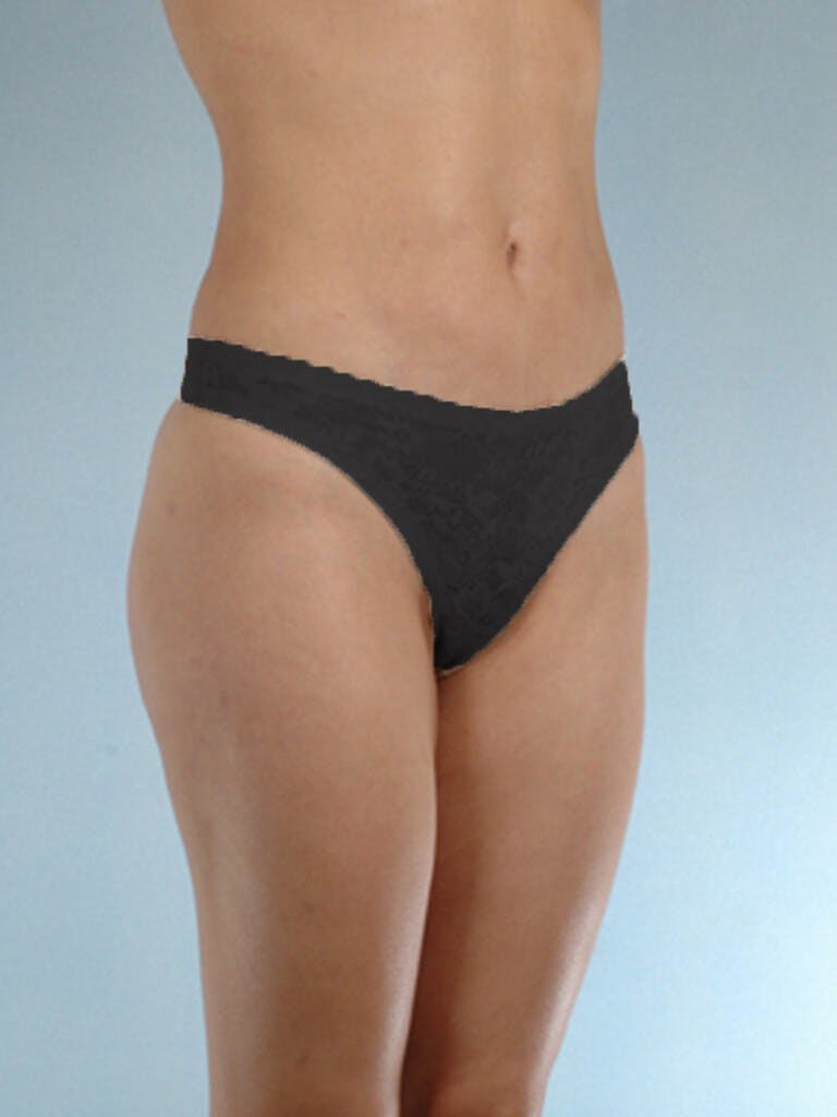 Brazilian Butt Lift Before & After Gallery - Patient 268116 - Image 6