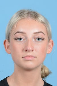 Rhinoplasty Before & After Gallery - Patient 197160 - Image 1