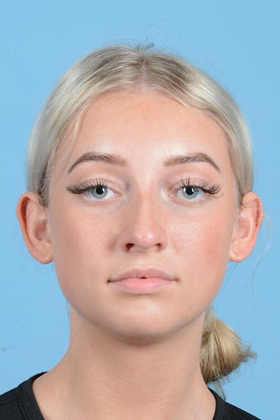 Rhinoplasty Before & After Gallery - Patient 197160 - Image 1
