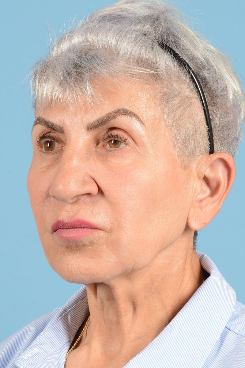 Facelift Before & After Gallery - Patient 336103 - Image 7