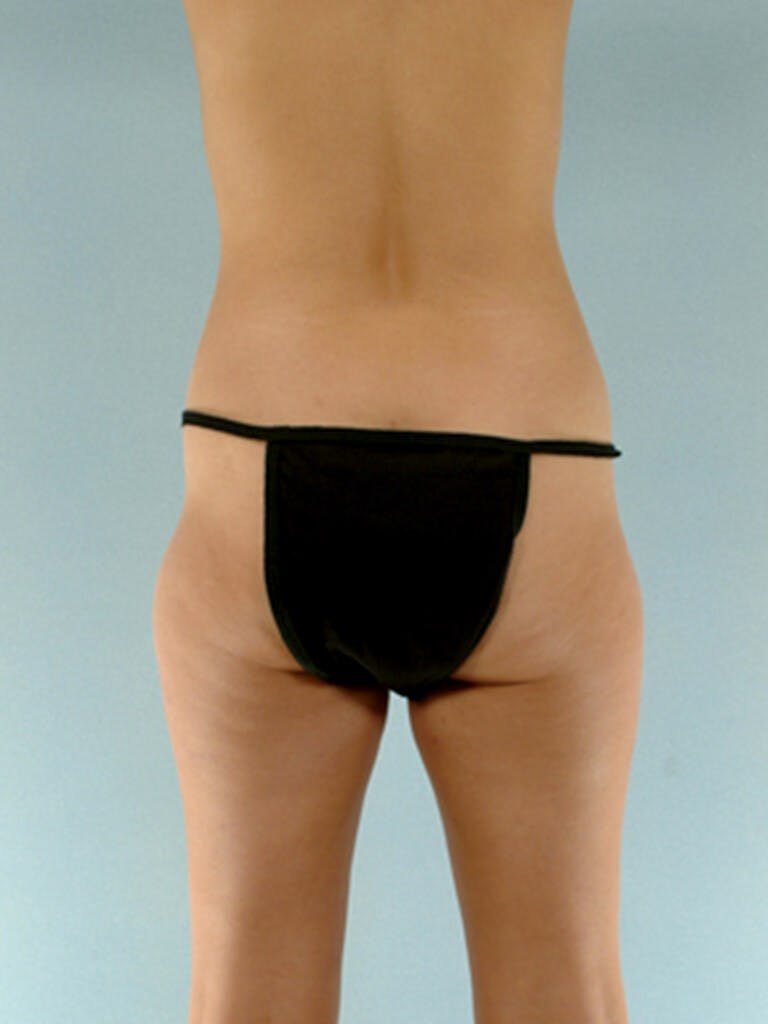 Brazilian Butt Lift Before & After Gallery - Patient 268116 - Image 7