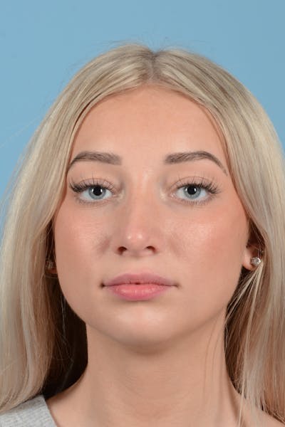 Rhinoplasty Before & After Gallery - Patient 197160 - Image 2