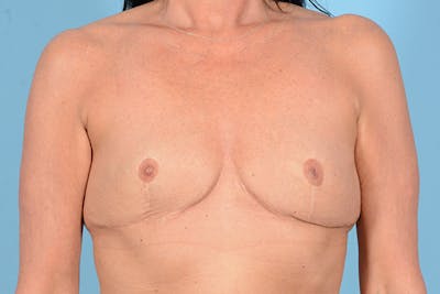 Liposuction Before & After Gallery - Patient 323086 - Image 1