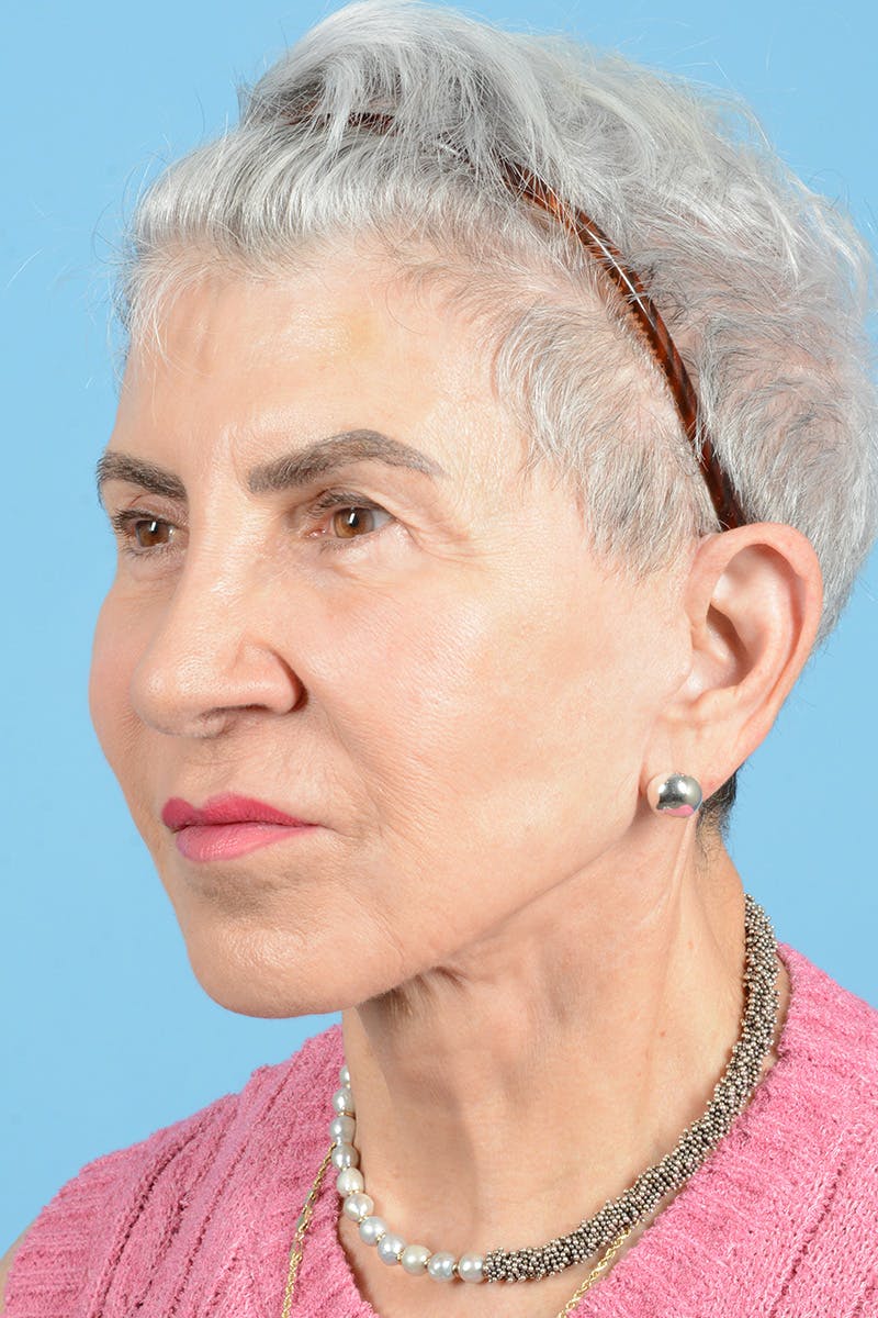 Facelift Before & After Gallery - Patient 336103 - Image 8