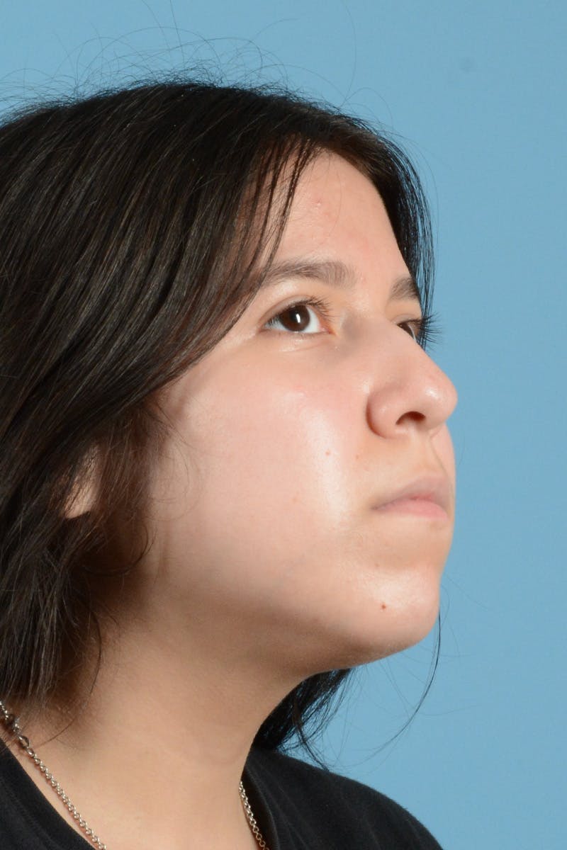 Facial Augmentation Before & After Gallery - Patient 217075 - Image 3