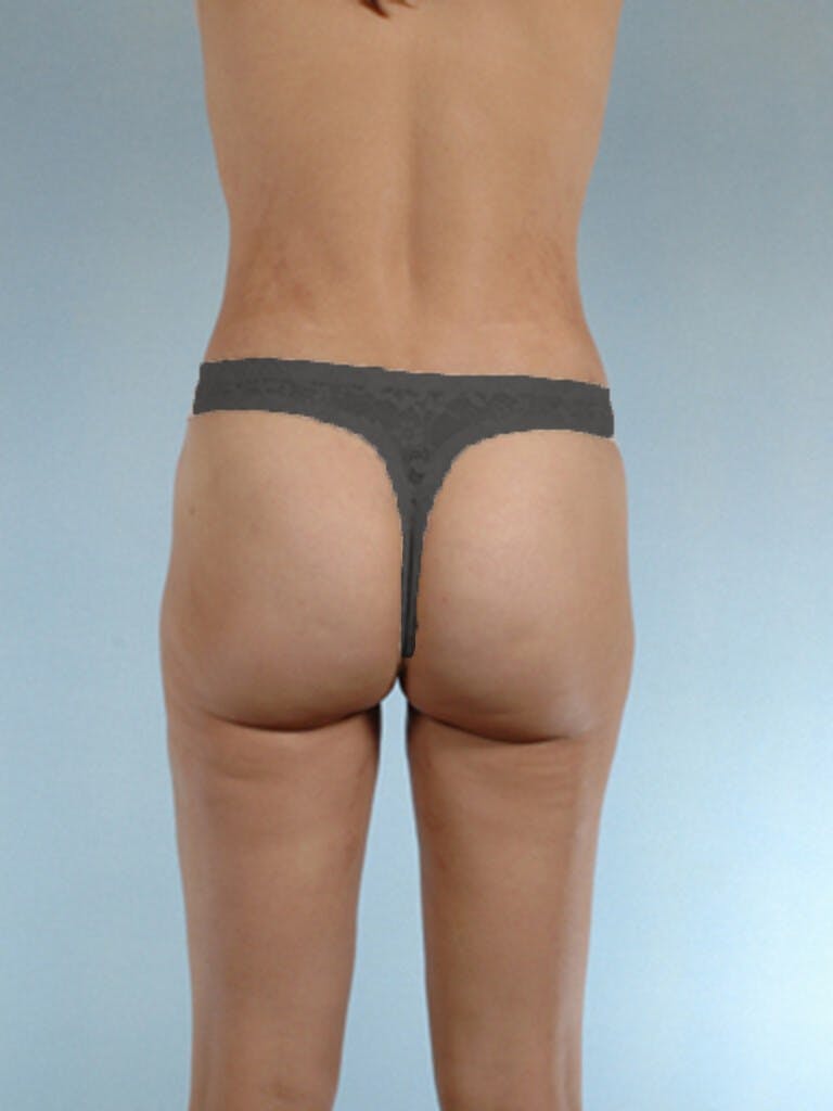Brazilian Butt Lift Before & After Gallery - Patient 268116 - Image 8