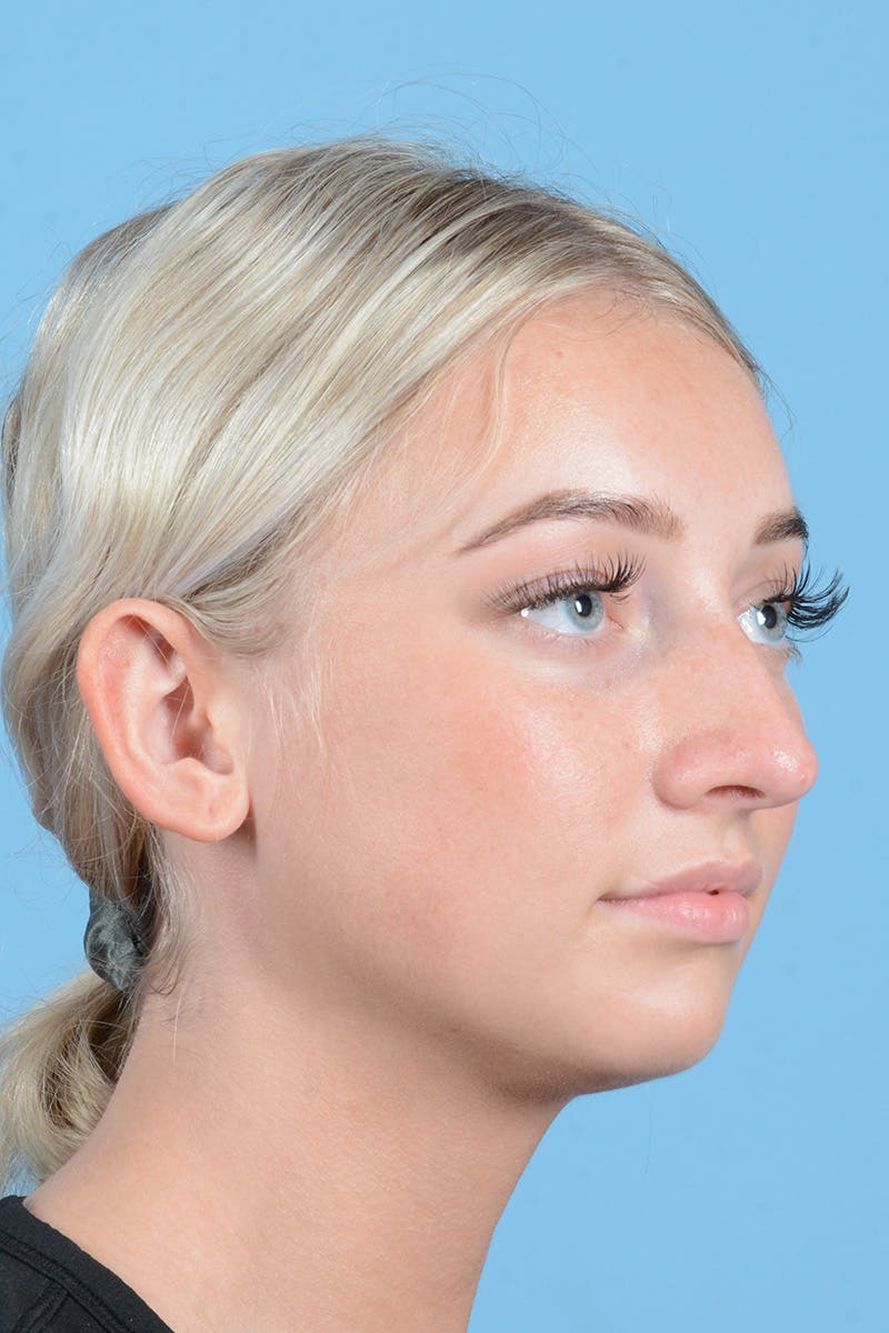 Rhinoplasty Before & After Gallery - Patient 197160 - Image 3