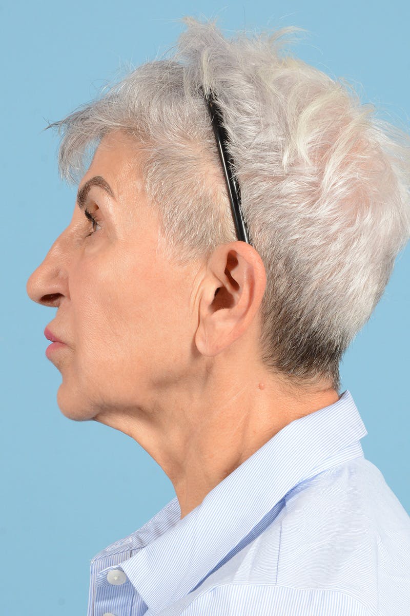 Facelift Before & After Gallery - Patient 336103 - Image 9