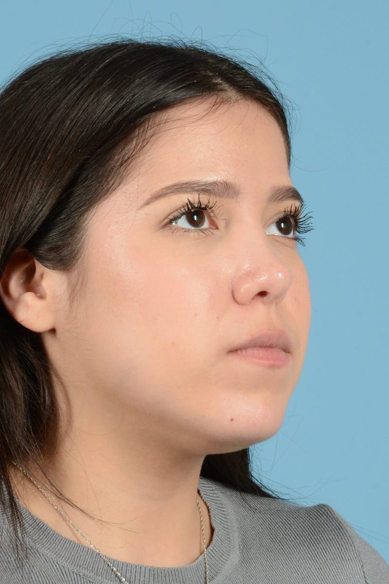 Facial Augmentation Before & After Gallery - Patient 217075 - Image 4