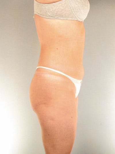 Brazilian Butt Lift Before & After Gallery - Patient 426147 - Image 1