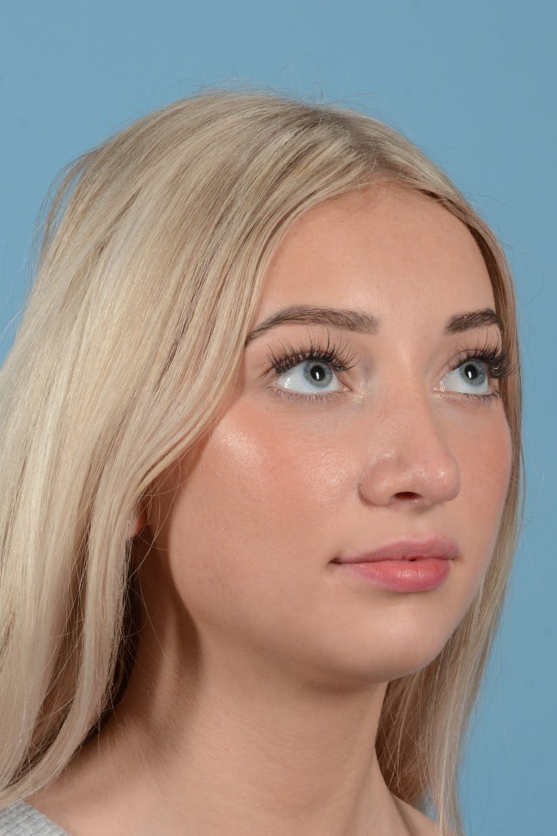 Rhinoplasty Before & After Gallery - Patient 197160 - Image 4