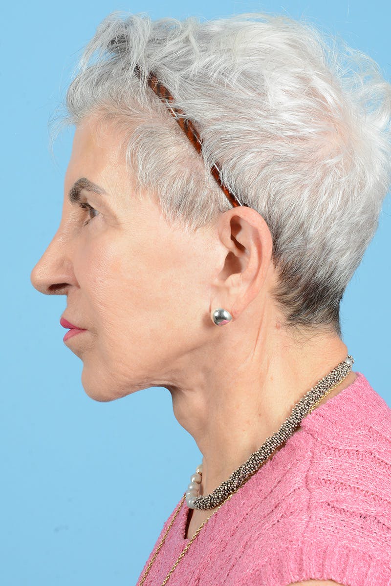 Facelift Before & After Gallery - Patient 336103 - Image 10