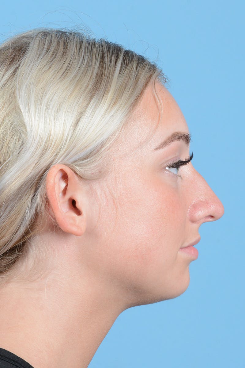 Rhinoplasty Before & After Gallery - Patient 197160 - Image 5