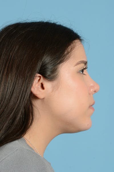 Facial Augmentation Before & After Gallery - Patient 217075 - Image 6