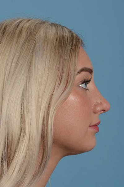 Rhinoplasty Before & After Gallery - Patient 197160 - Image 6