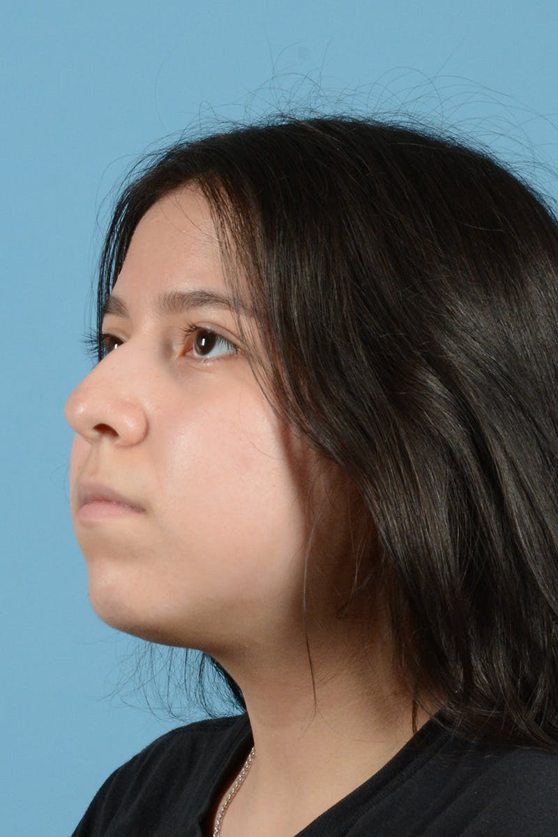 Facial Augmentation Before & After Gallery - Patient 217075 - Image 7