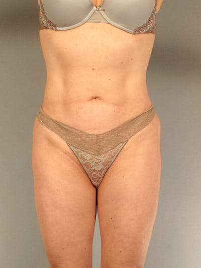 Brazilian Butt Lift Before & After Gallery - Patient 426147 - Image 4