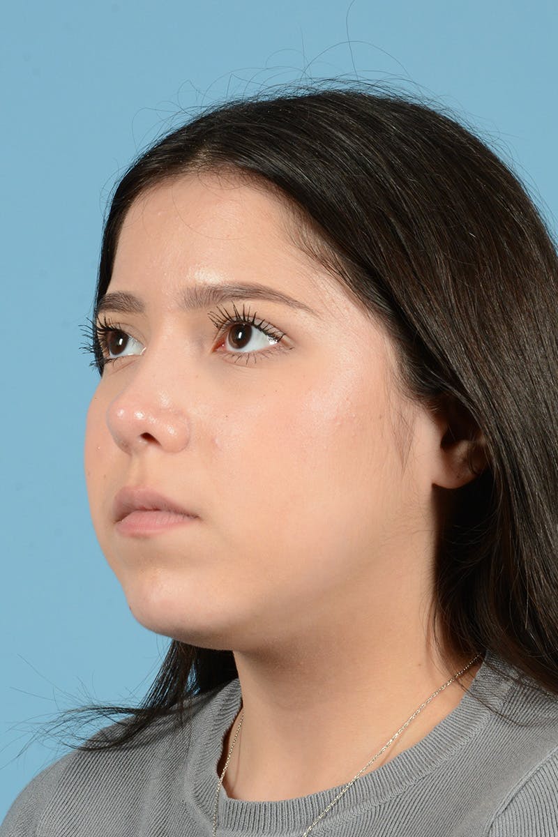 Facial Augmentation Before & After Gallery - Patient 217075 - Image 8