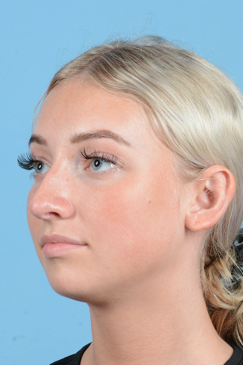 Rhinoplasty Before & After Gallery - Patient 197160 - Image 7