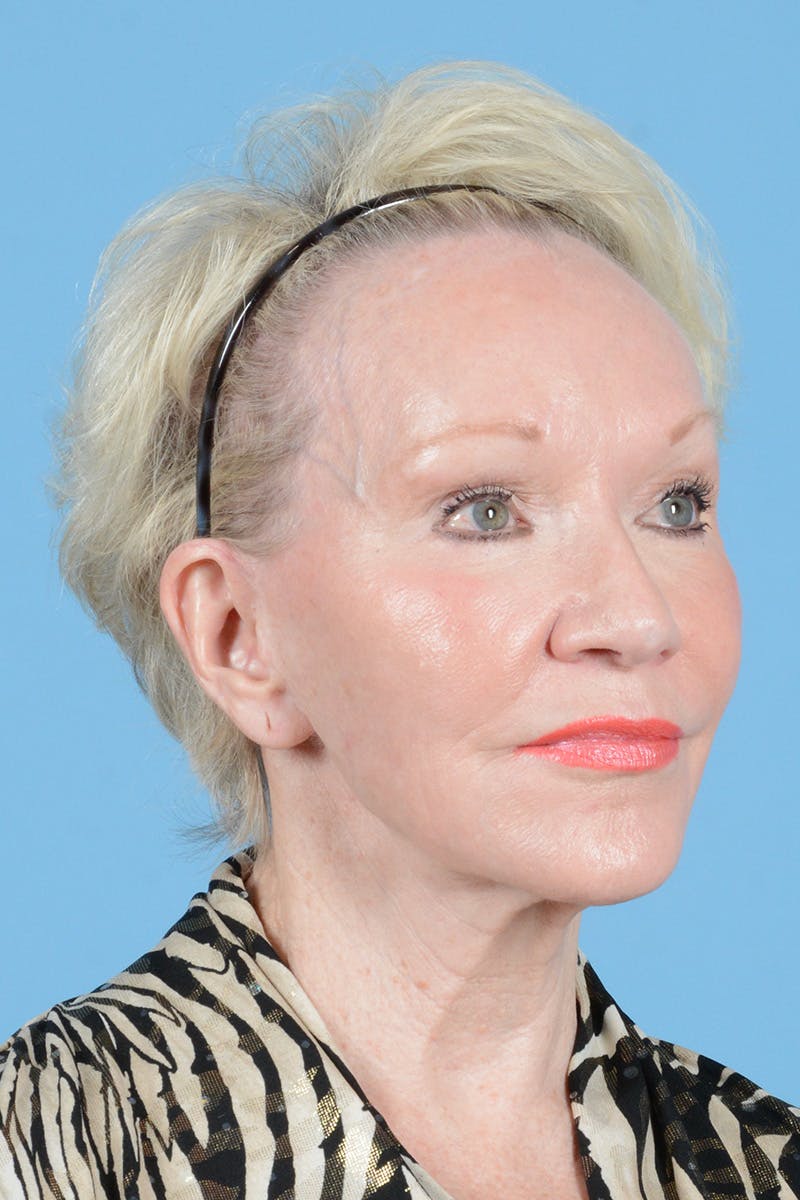 Facelift Before & After Gallery - Patient 914252 - Image 3