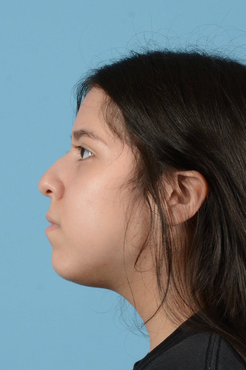 Facial Augmentation Before & After Gallery - Patient 217075 - Image 9