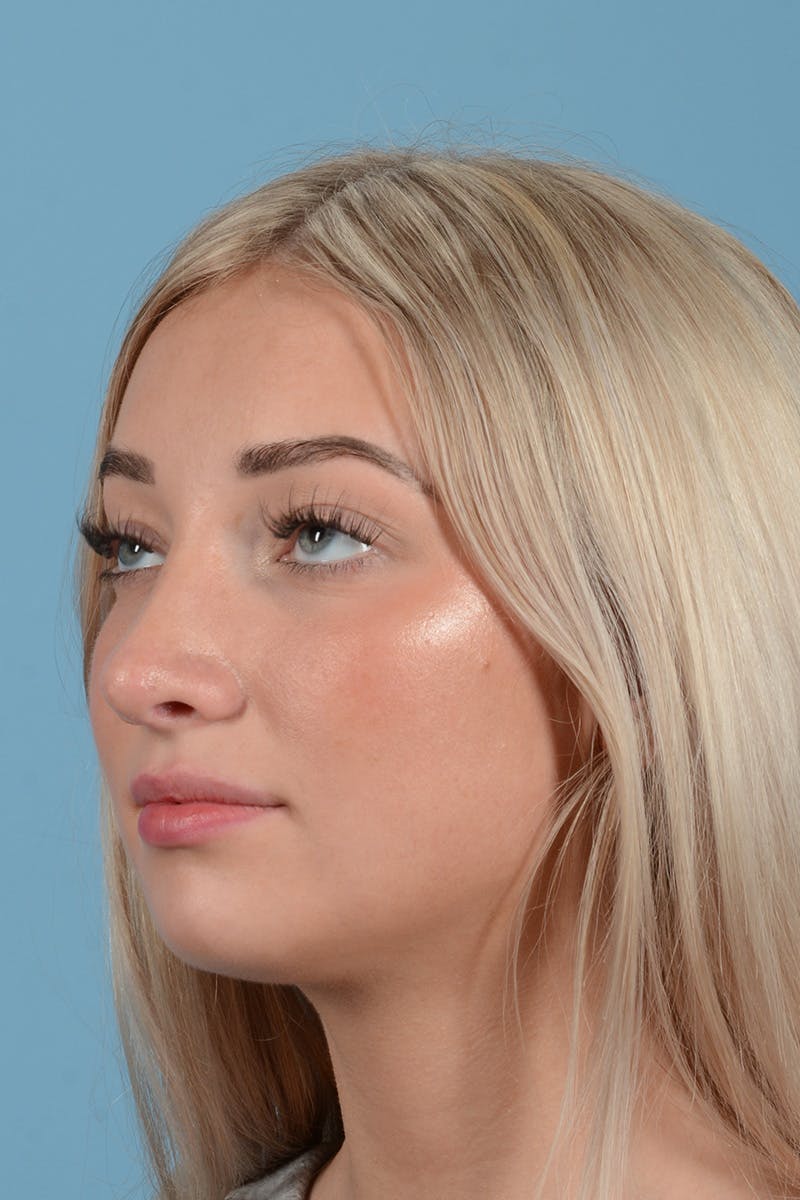 Rhinoplasty Before & After Gallery - Patient 197160 - Image 8