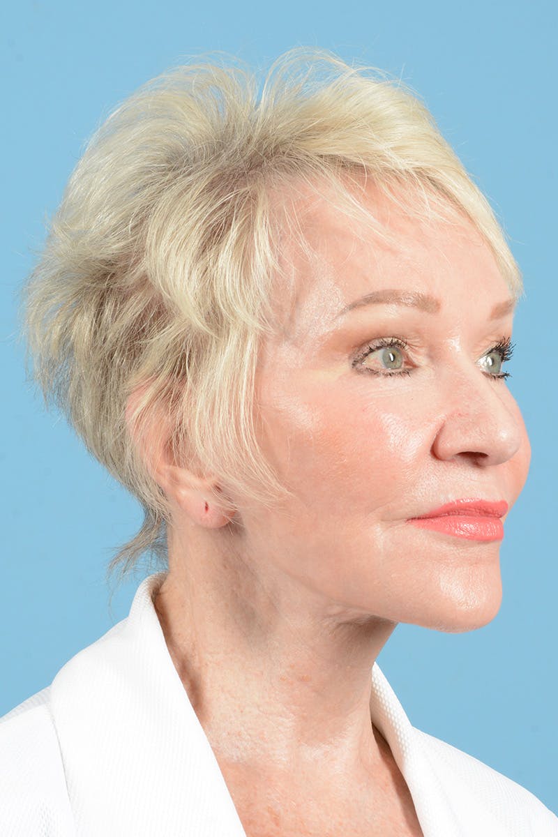 Facelift Before & After Gallery - Patient 914252 - Image 4