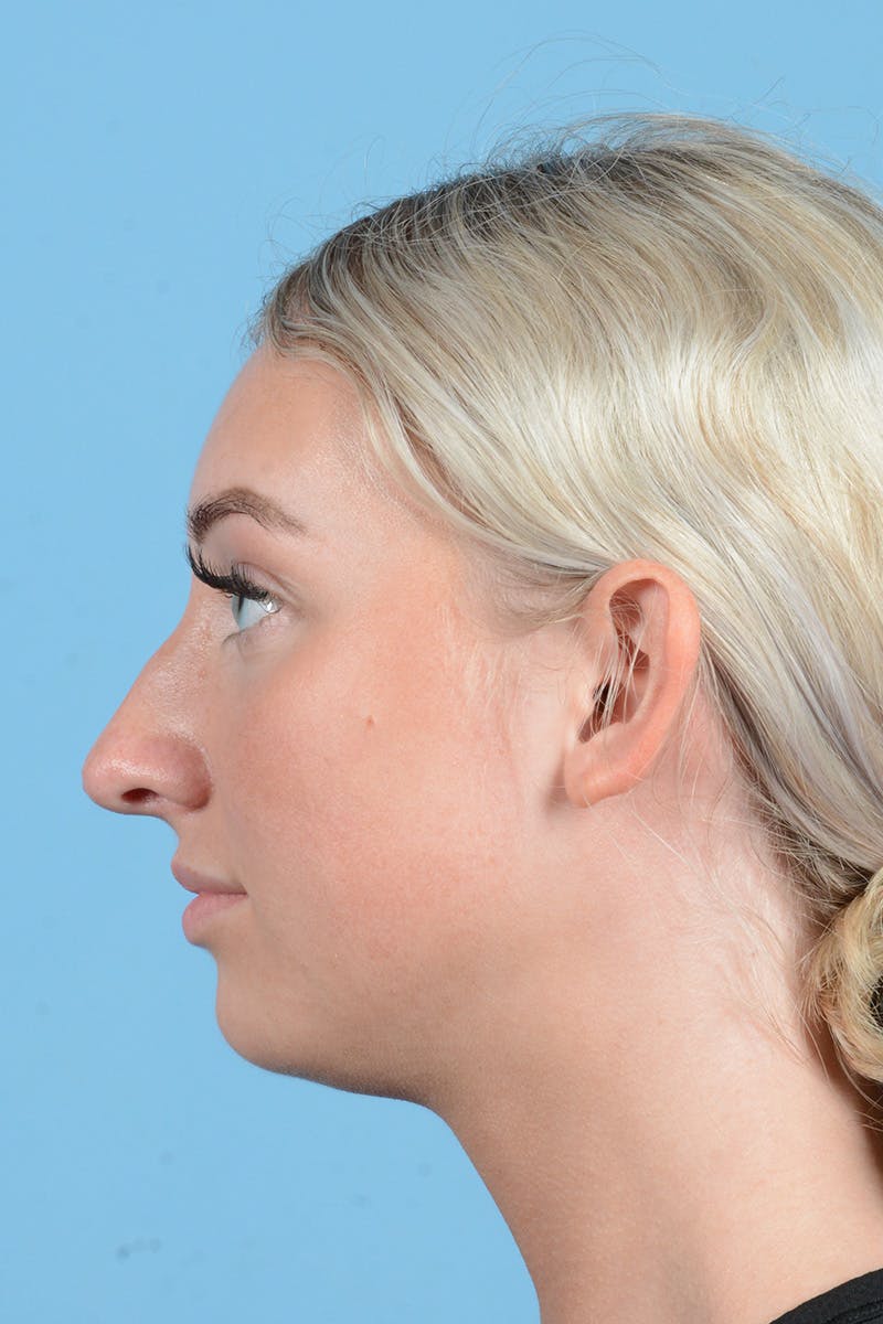 Rhinoplasty Before & After Gallery - Patient 197160 - Image 9