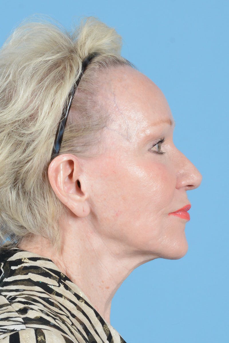 Facelift Before & After Gallery - Patient 914252 - Image 5