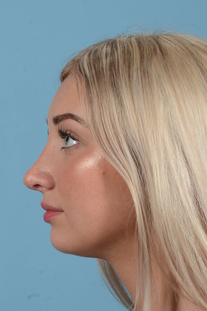 Rhinoplasty Before & After Gallery - Patient 197160 - Image 10
