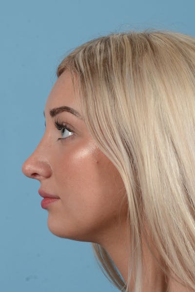 Rhinoplasty Before & After Gallery - Patient 197160 - Image 10