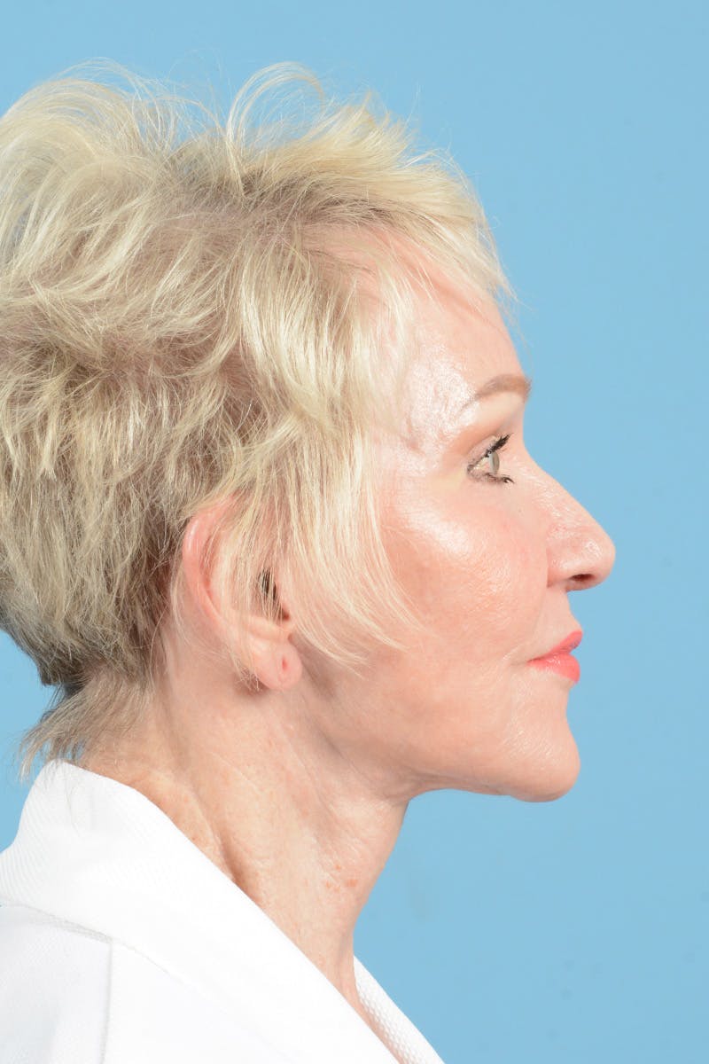 Facelift Before & After Gallery - Patient 914252 - Image 6