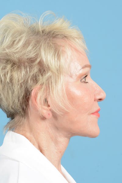 Facelift Before & After Gallery - Patient 914252 - Image 6