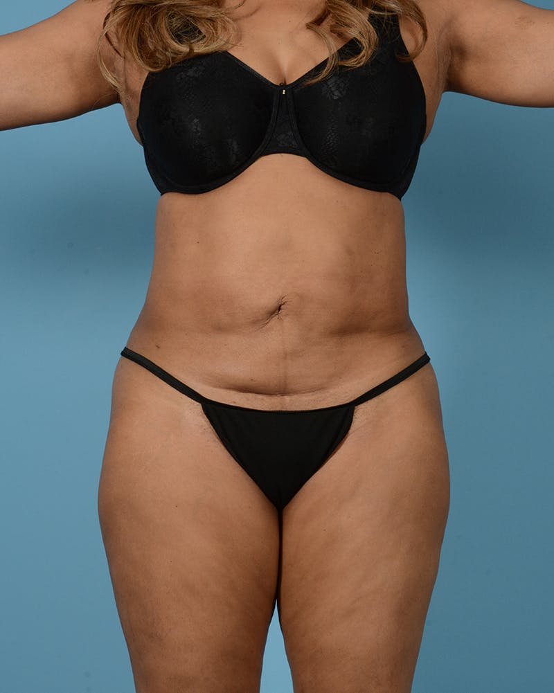 Brazilian Butt Lift Before & After Gallery - Patient 422389 - Image 1