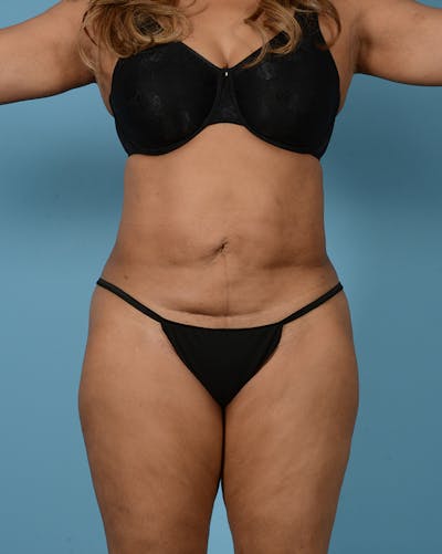 Brazilian Butt Lift Before & After Gallery - Patient 422389 - Image 1
