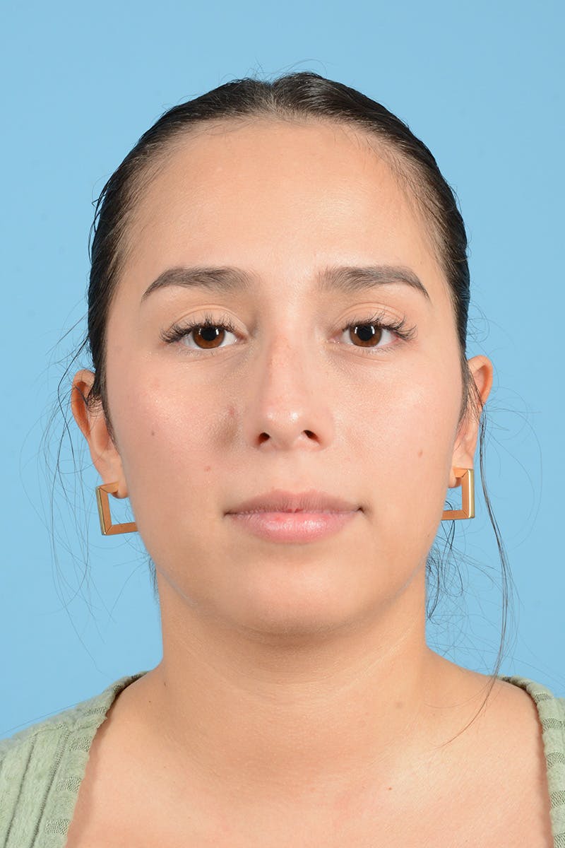 Rhinoplasty Before & After Gallery - Patient 206440 - Image 1