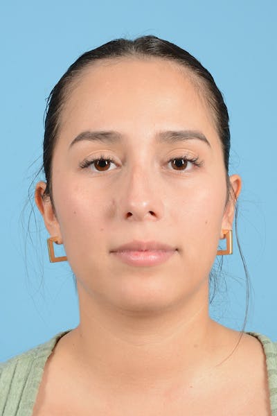 Rhinoplasty Before & After Gallery - Patient 206440 - Image 1