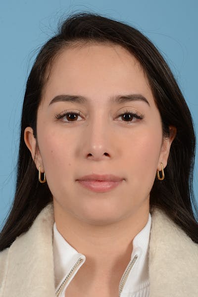 Rhinoplasty Before & After Gallery - Patient 206440 - Image 2