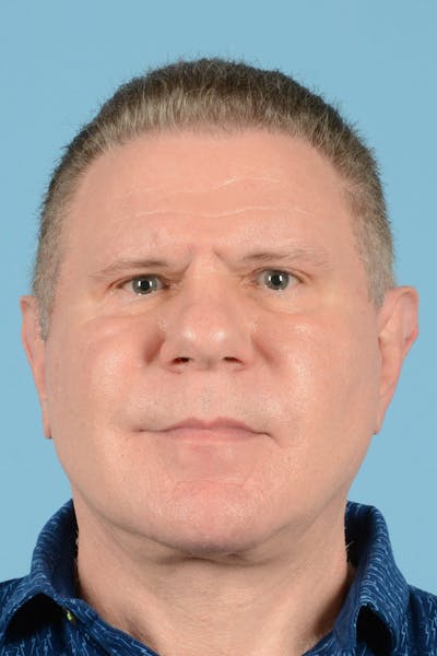Facial Augmentation Before & After Gallery - Patient 242387 - Image 2