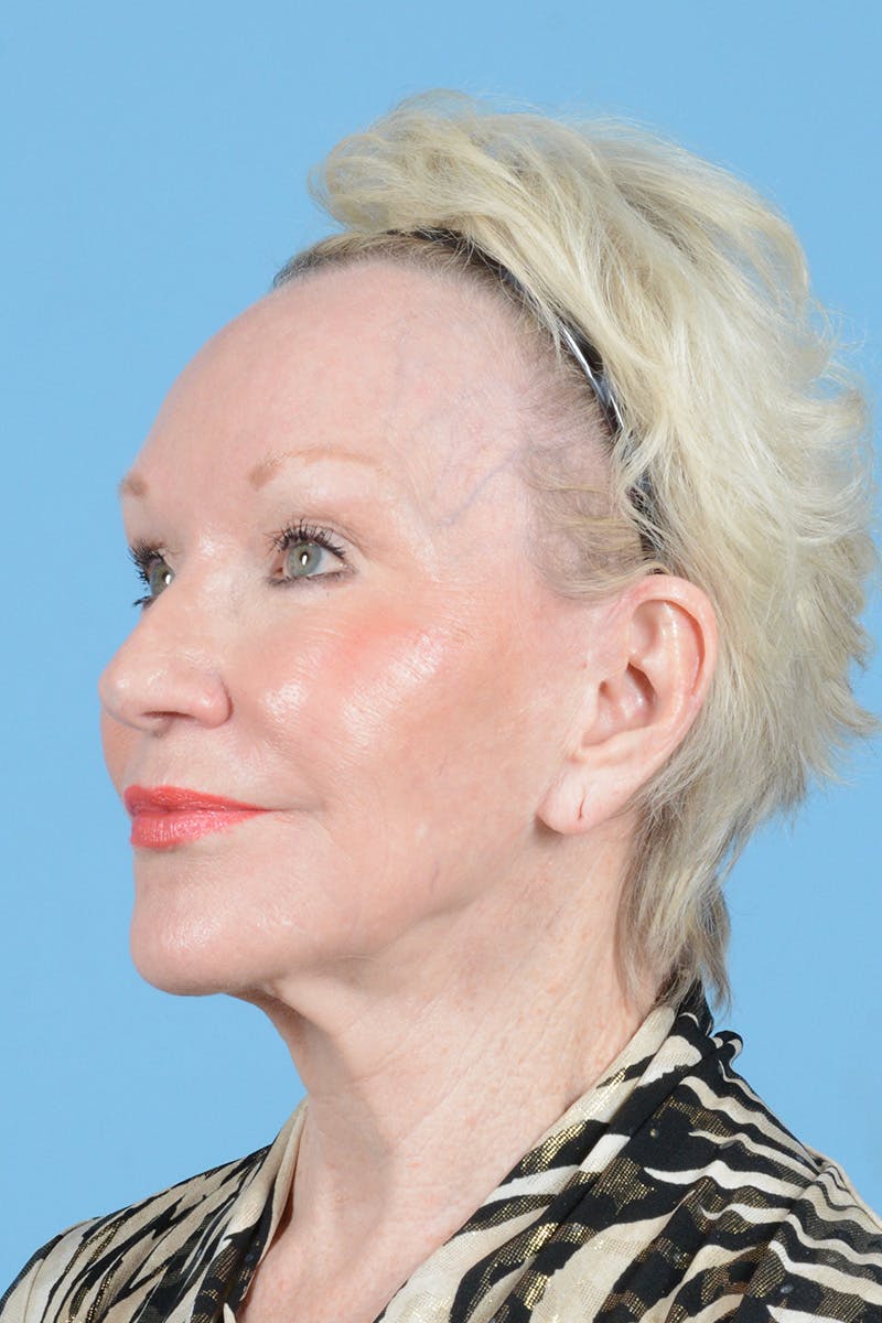 Facelift Before & After Gallery - Patient 914252 - Image 7