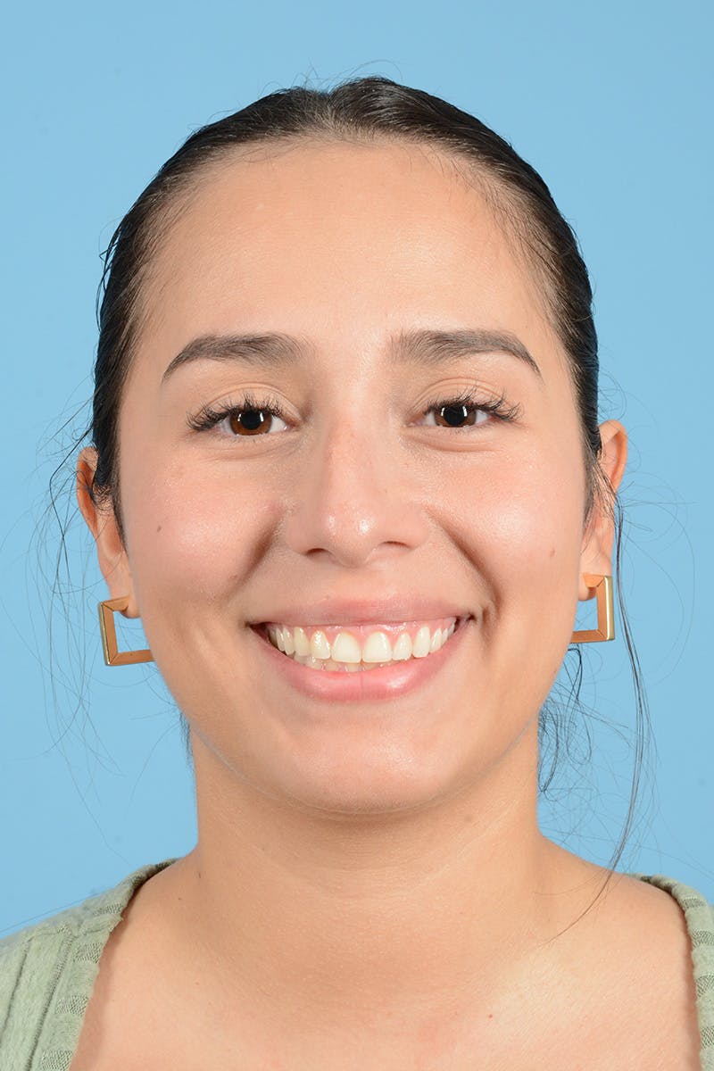Rhinoplasty Before & After Gallery - Patient 206440 - Image 3