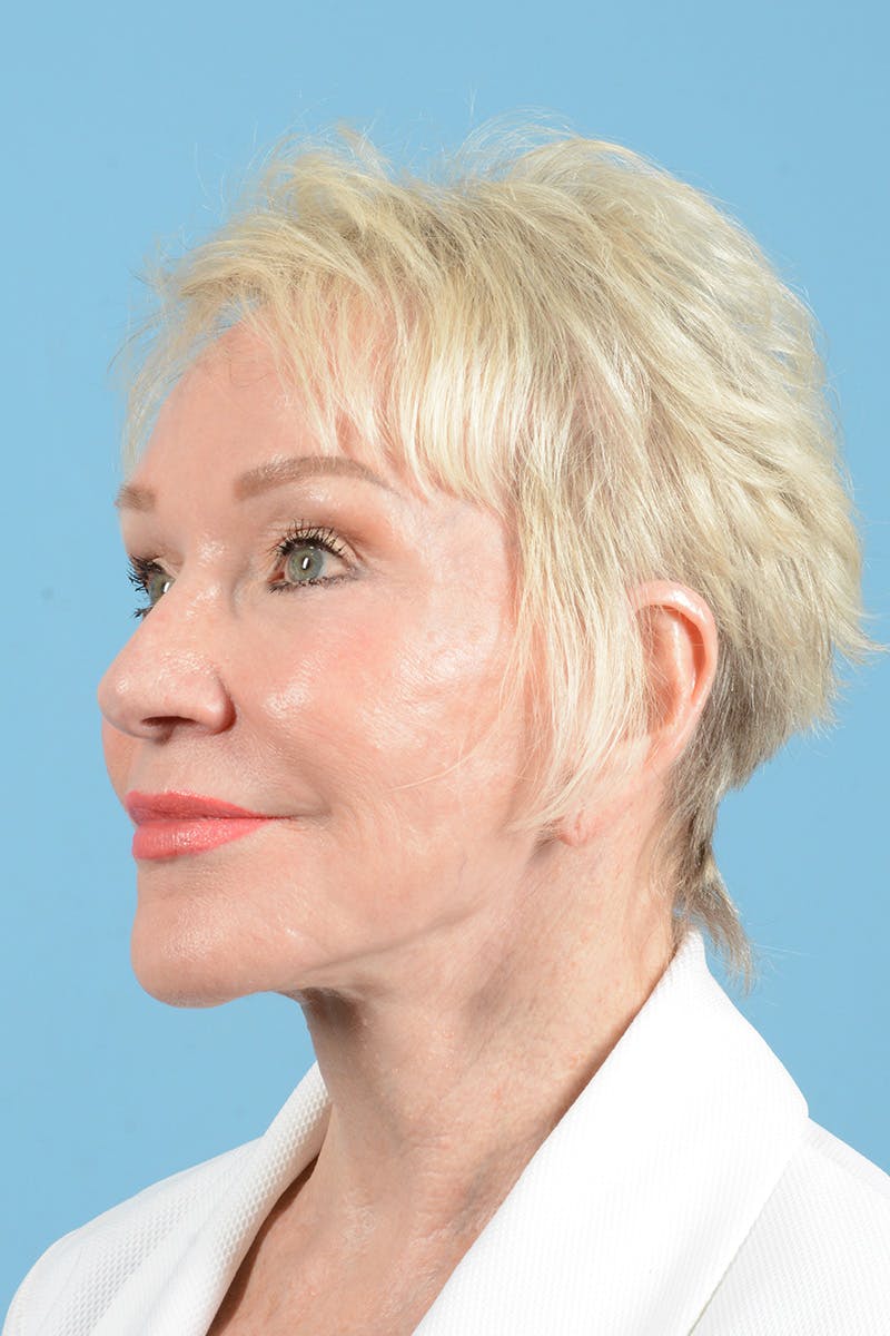 Facelift Before & After Gallery - Patient 914252 - Image 8