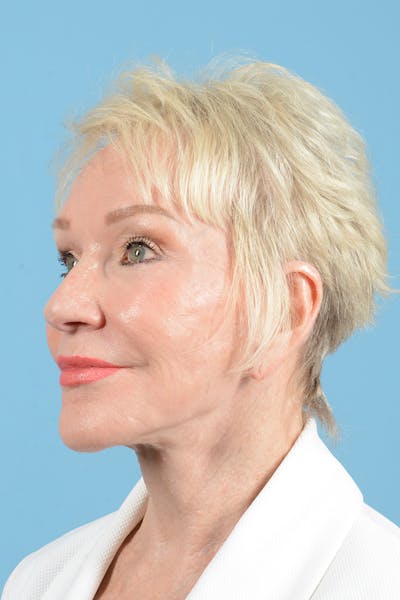 Facelift Before & After Gallery - Patient 914252 - Image 8