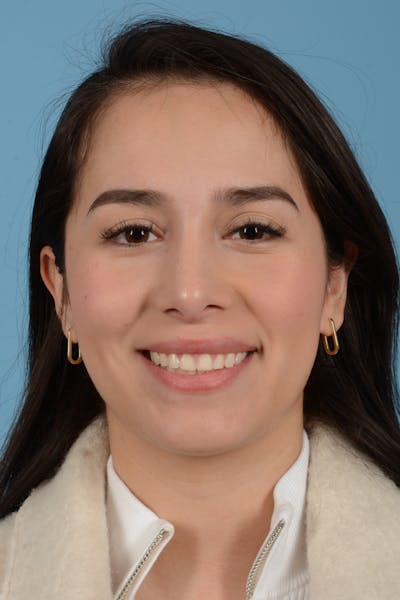 Rhinoplasty Before & After Gallery - Patient 206440 - Image 4