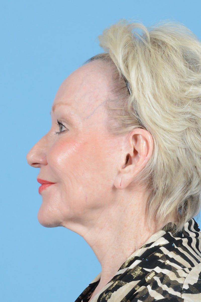 Facelift Before & After Gallery - Patient 914252 - Image 9
