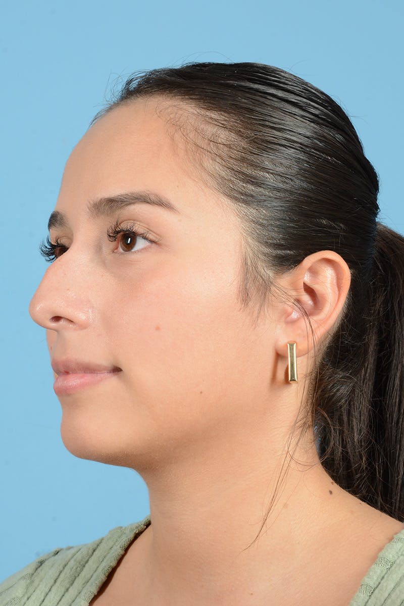 Rhinoplasty Before & After Gallery - Patient 206440 - Image 5