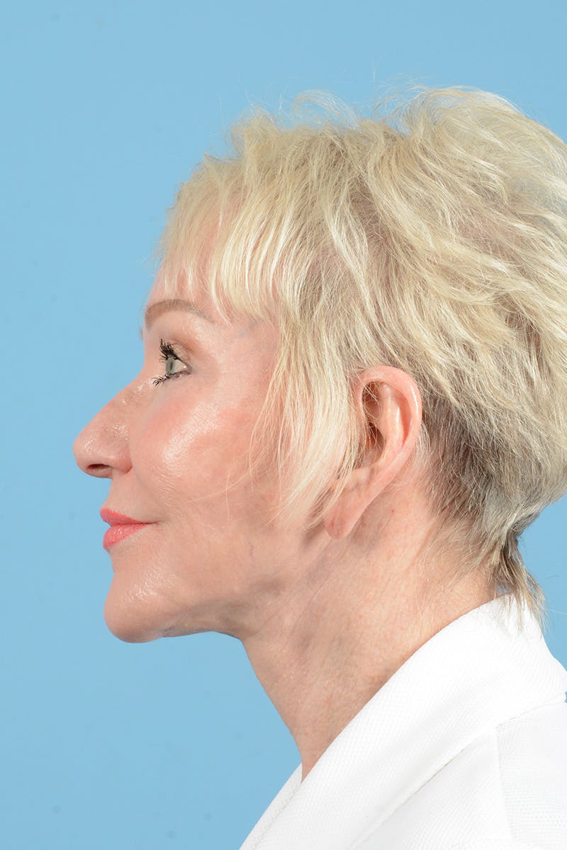 Eyelid Lift Before & After Gallery - Patient 123527 - Image 10