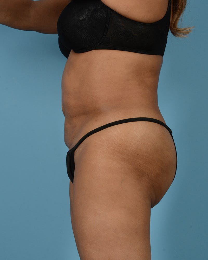 Brazilian Butt Lift Before & After Gallery - Patient 422389 - Image 5