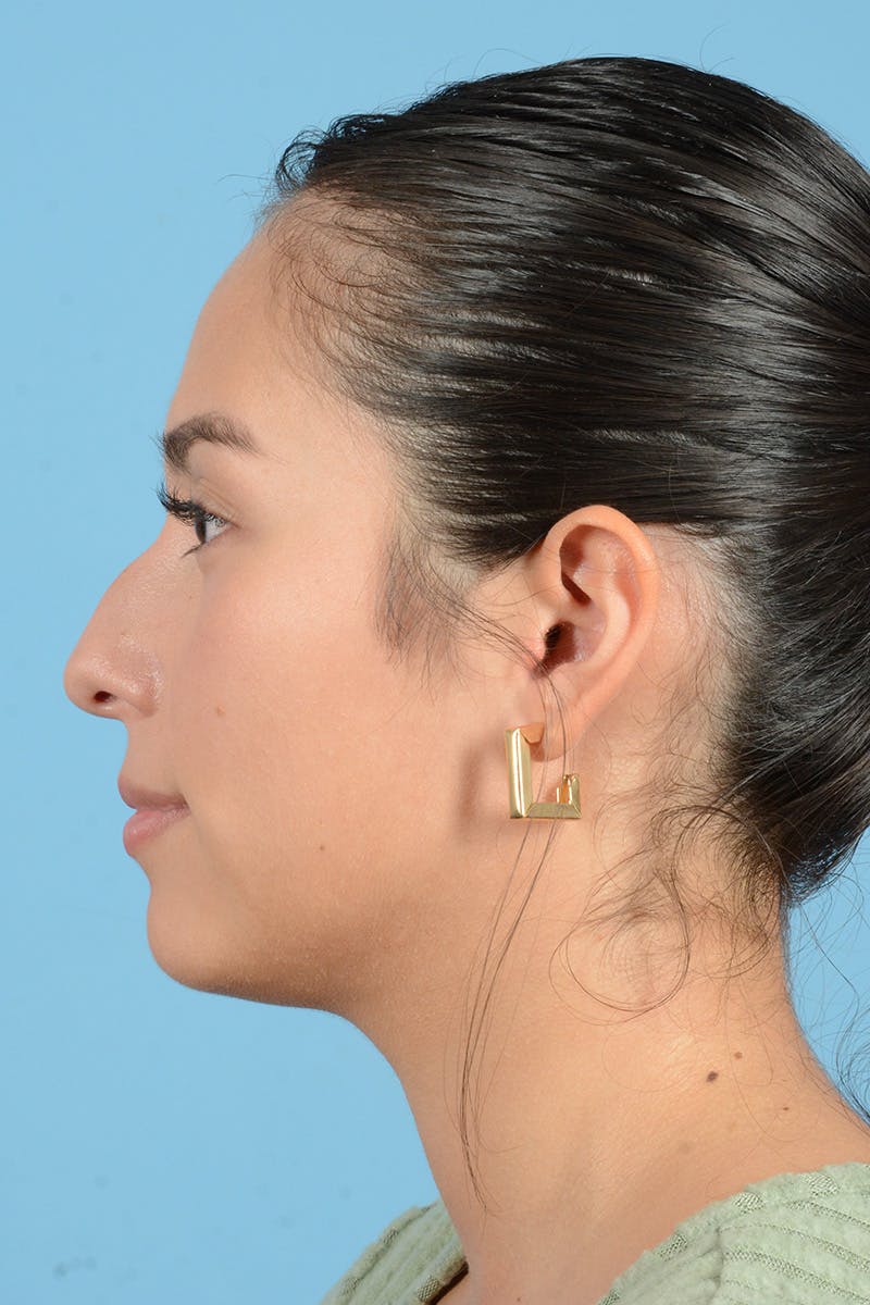 Rhinoplasty Before & After Gallery - Patient 206440 - Image 7